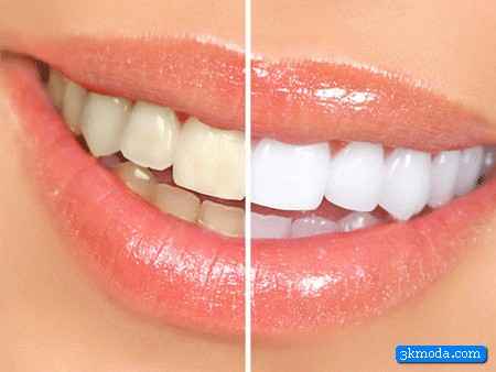 Diş beyazlatma yolları