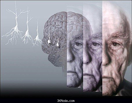 Alzheimer hastalığı